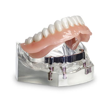 Overdenture
